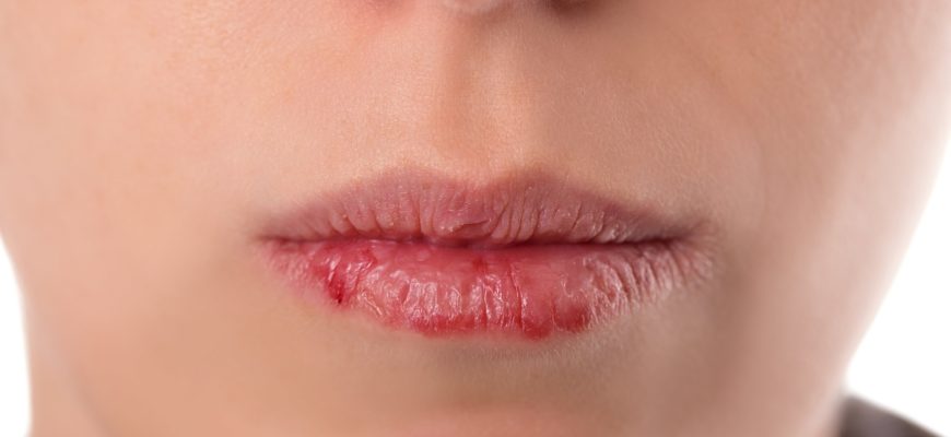 Раздраженные губы у человека